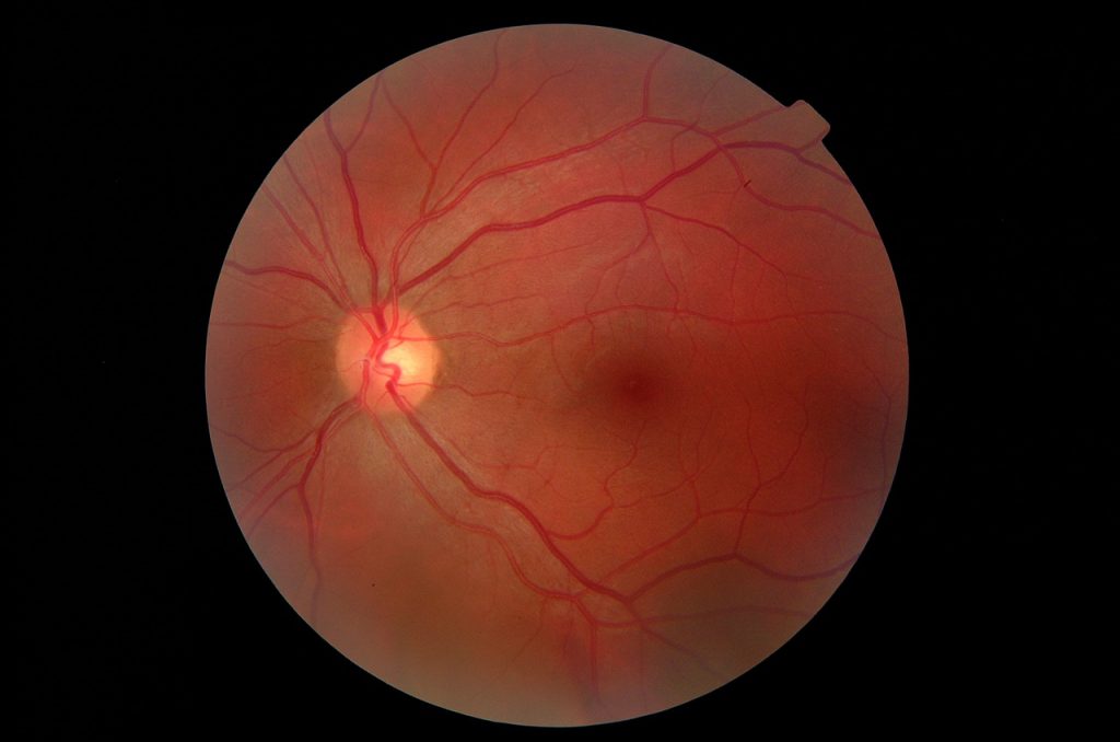 eye, fundus, close
